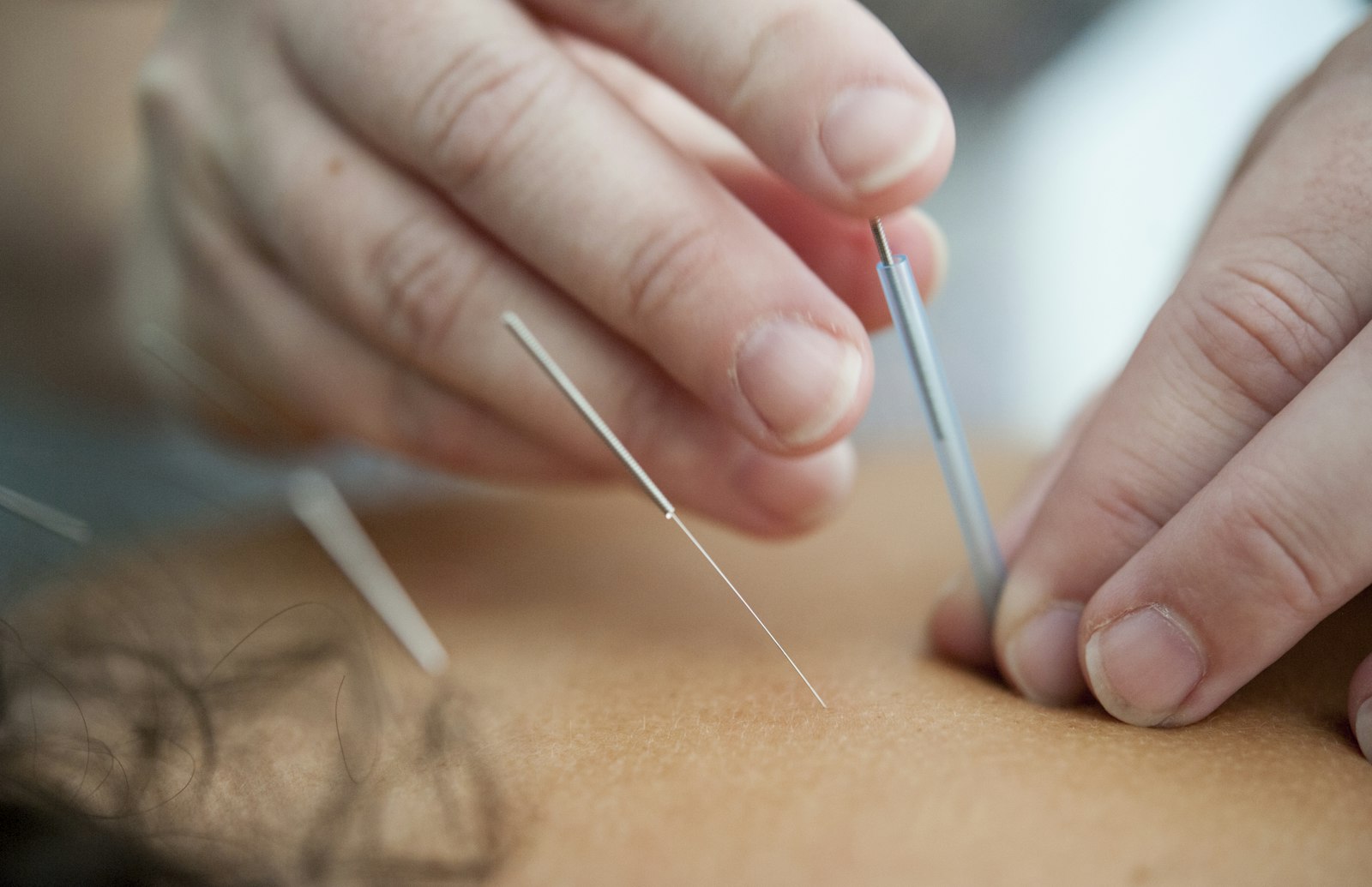 Terapeuta aplicando acupuntura em paciente relaxado em maca de terapia